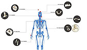 PEEK - Human Implant Repair Material